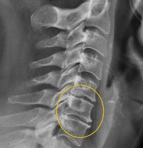 ostéochondrose cervicale